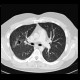 Wegener's granulomatosis, HRCT, follow-up: CT - Computed tomography